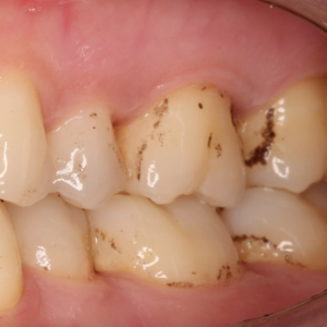 Razón Susceptibles a Tóxico Manchas negras en los dientes | Clínica Dental Olivares